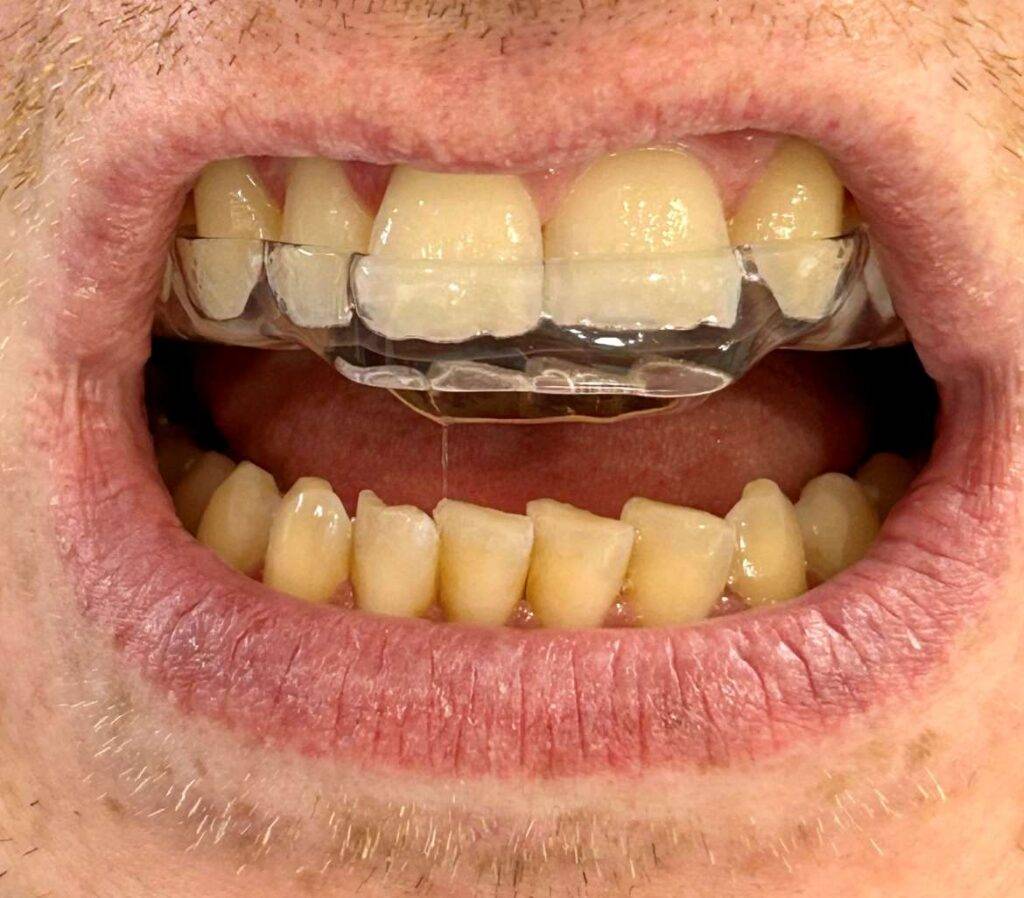 TMJ Dysfunction Treatment in Teignmouth