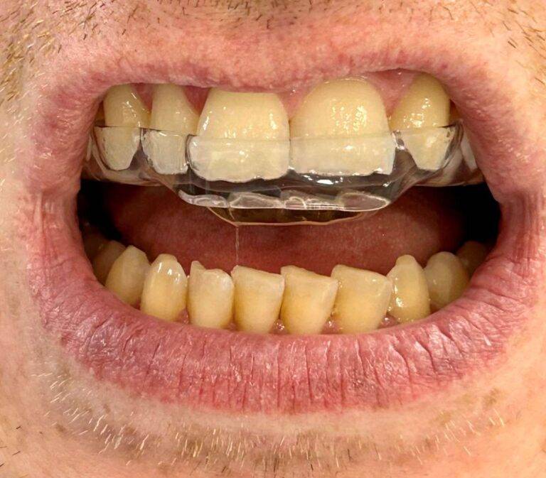 TMJ Dysfunction Treatment in Teignmouth
