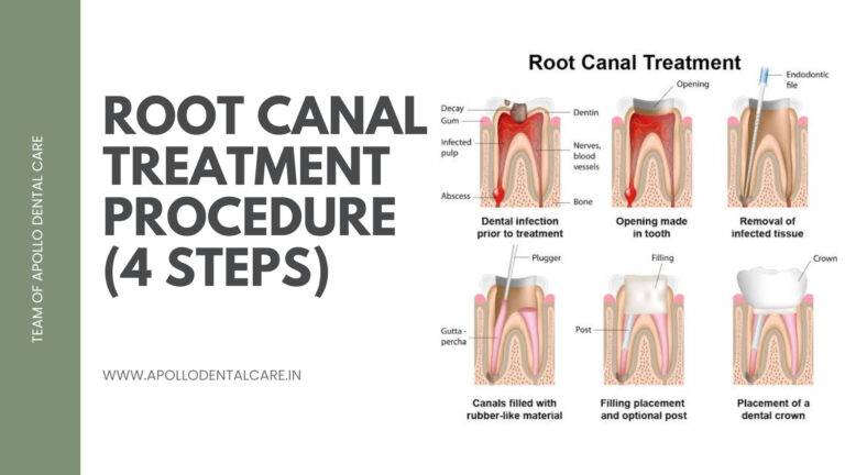 Root Canal Treatment