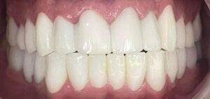 Turkey Teeth Problems