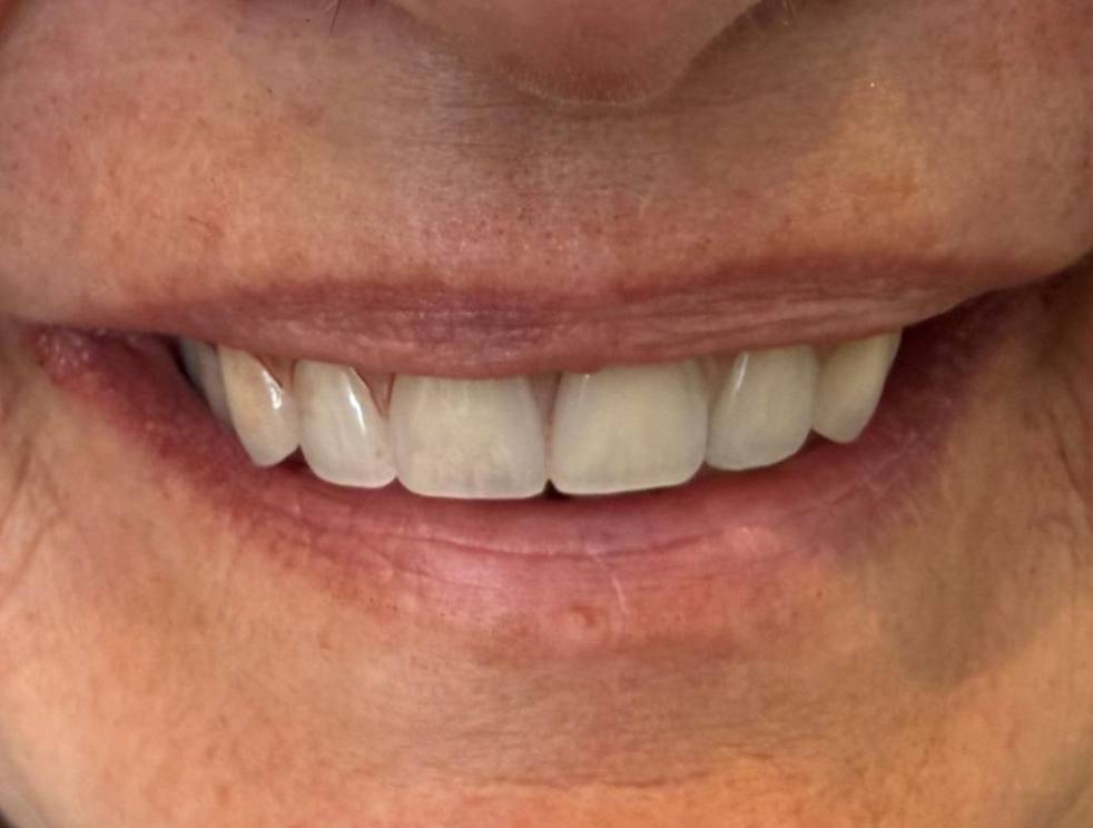 Dental Implants Teignmouth