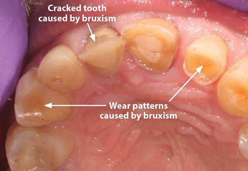 Bruxism