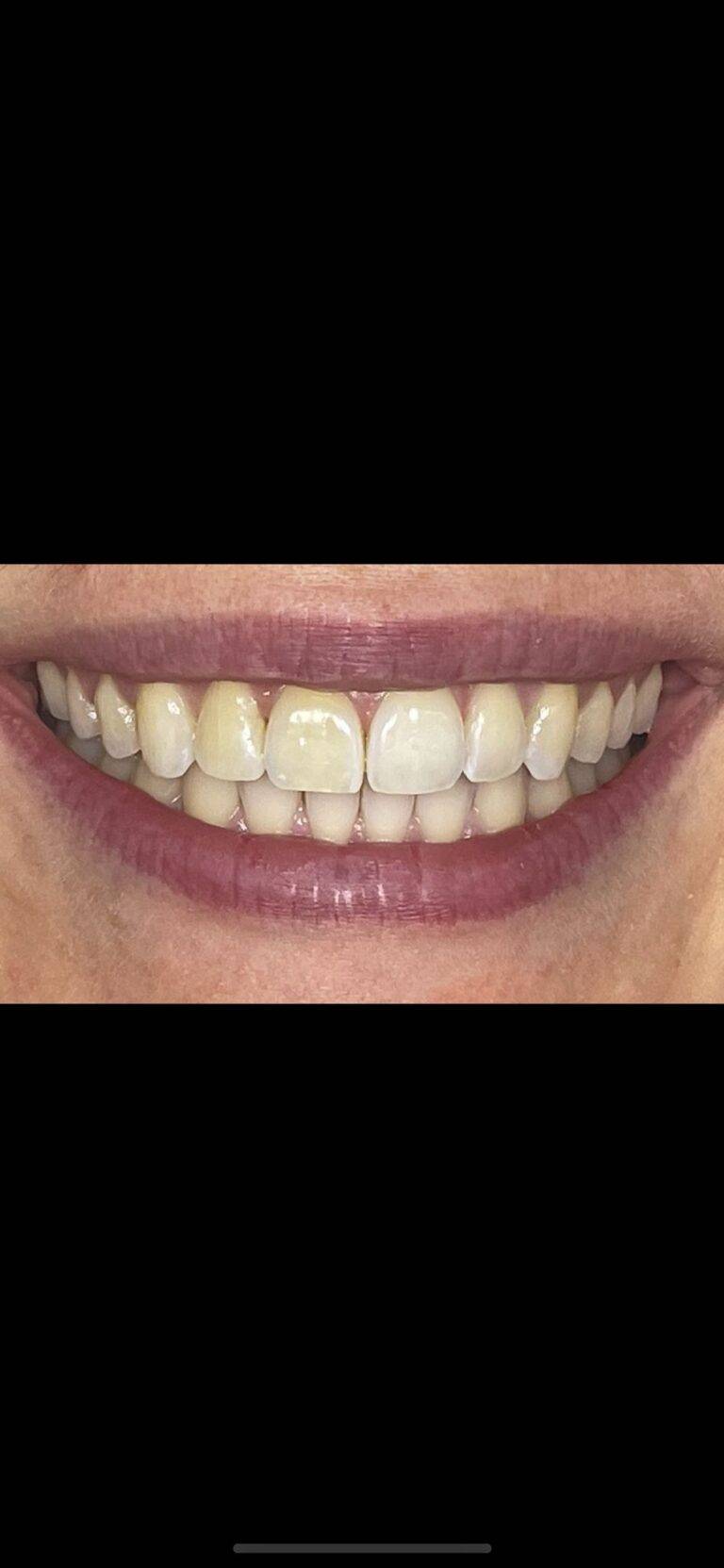 Teeth Straightening Teignmouth